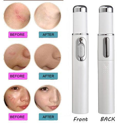 Blue Light Therapy Acne Laser Pen - Soft Scar & Wrinkle Removal Treatment Device for Skin Care